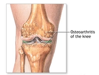Kıkırdak Aşınması Belirtileri ve Tedavisi Kıkırdak Aşınması Belirtileri ve Tedavisi