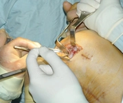 Kıkırdak Yırtılması Belirtileri ve Tedavisi Kıkırdak Yırtılması Belirtileri ve Tedavisi