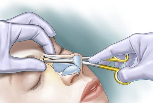 Buruna Kıkırdak Ekleme Tedavisi