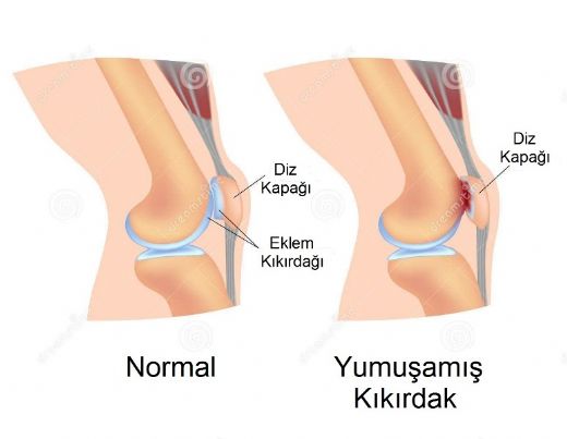 Dizde Kkrdak Zedelenmesi